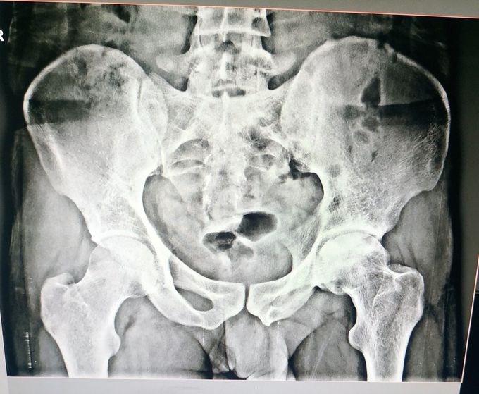X-Ray pelvis...