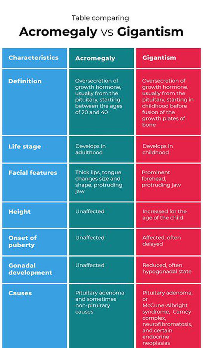 Gigantism Vs Acromegaly