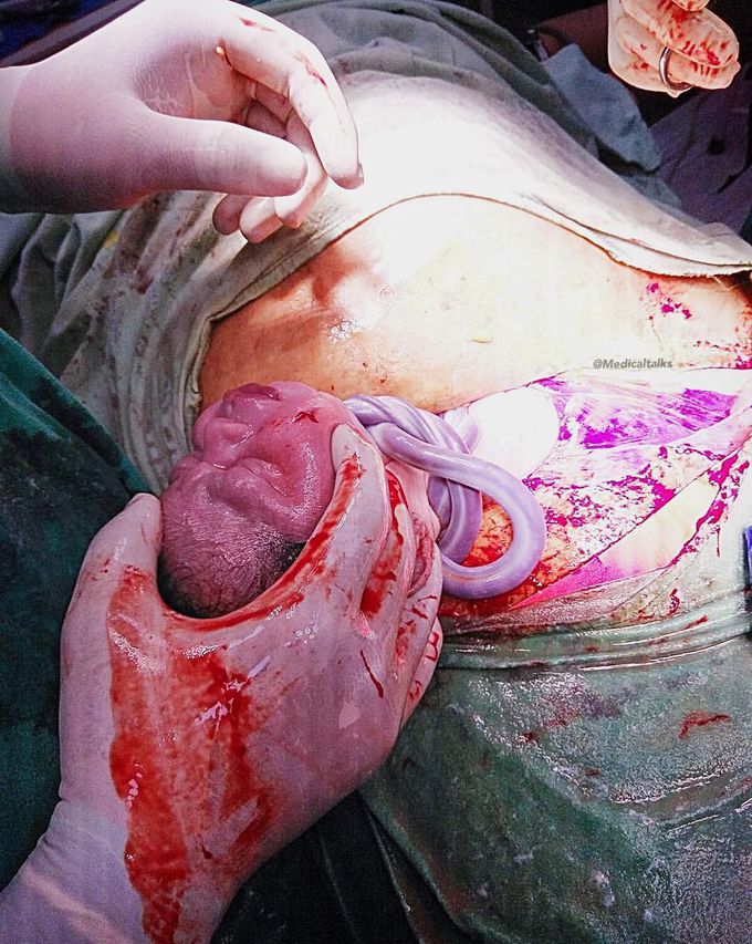 Nuchal cord with multiple loops!  