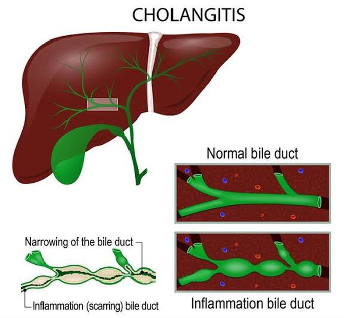 Cholangitis