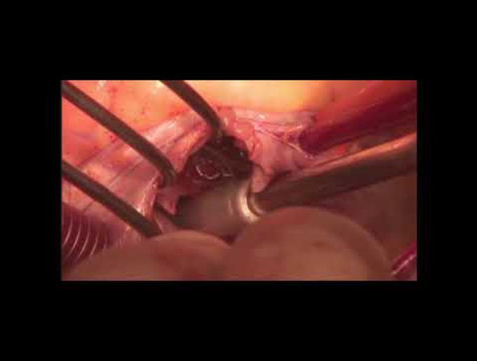 Repair of Rare Direct Gerbode Defect Secondary to Aortic and Tricuspid Valve Endocarditis