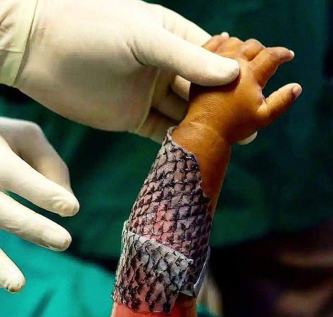 Pediatric Burn Treatment Using Tilapia Skin