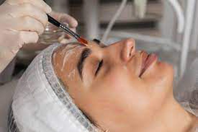 Chemical peel