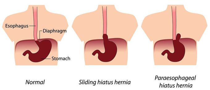 Hiatus hernia