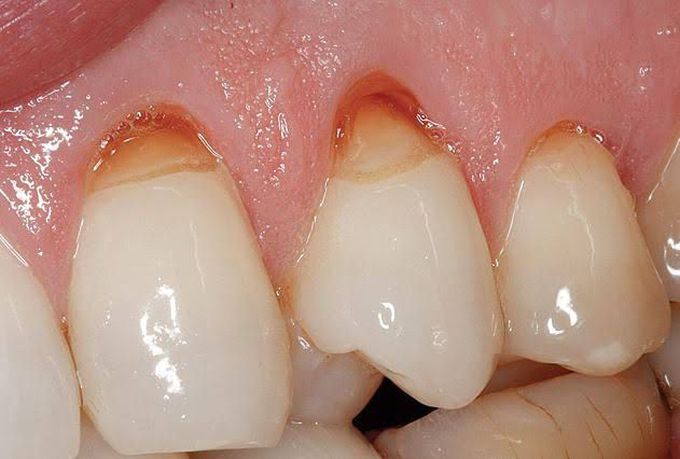 Abrasion of tooth