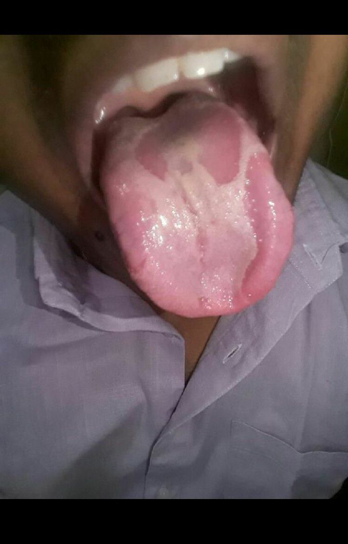 Identify the condition of tongue!!