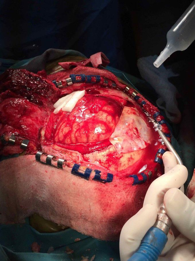 Neurosurgery