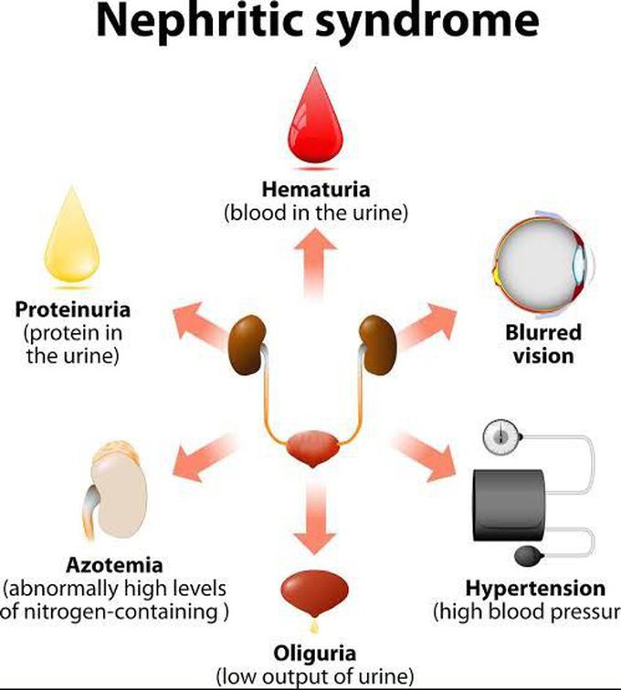 Nephrotic syndrome