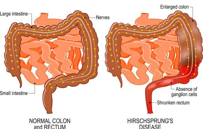 Hirschsprung disease