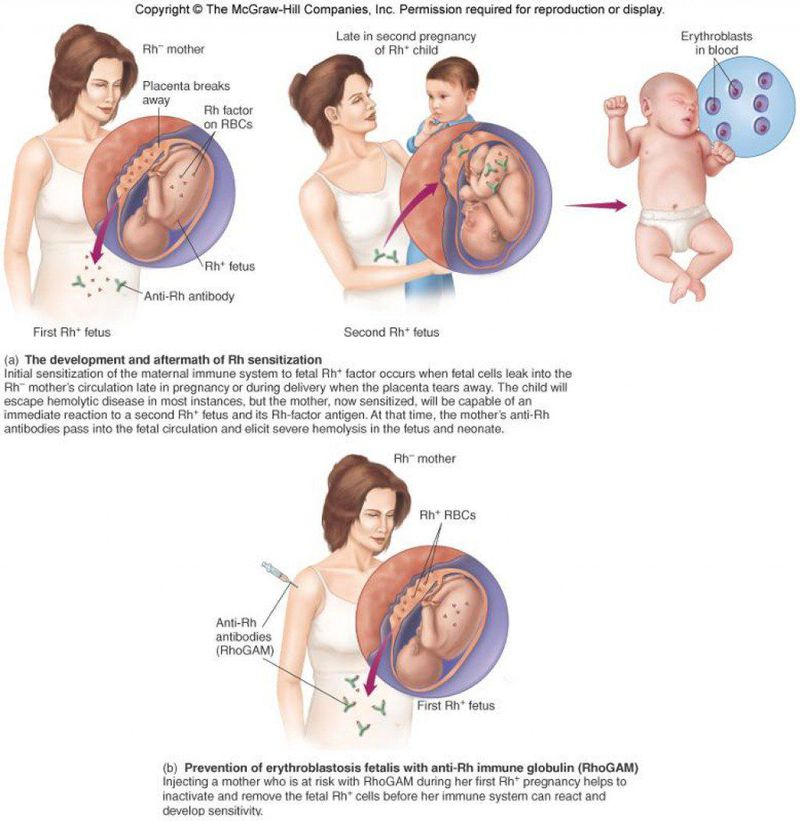 hemolytic disease of the newborn