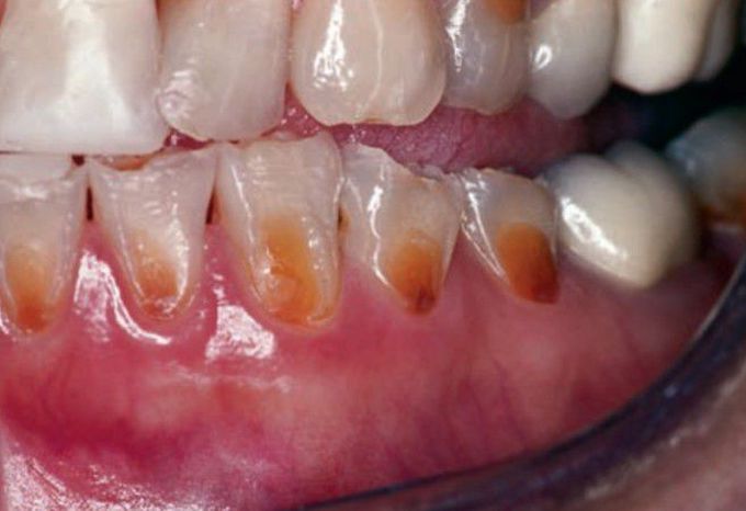 Erosion of teeth