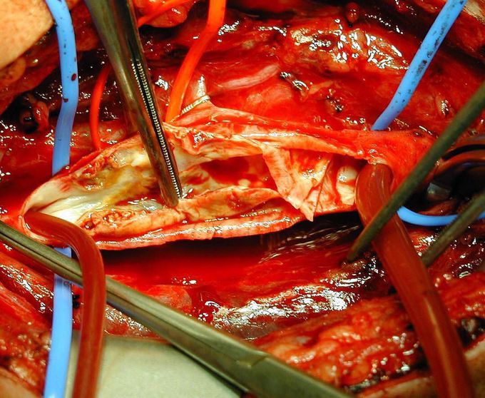 Carotid endarterectomy procedure