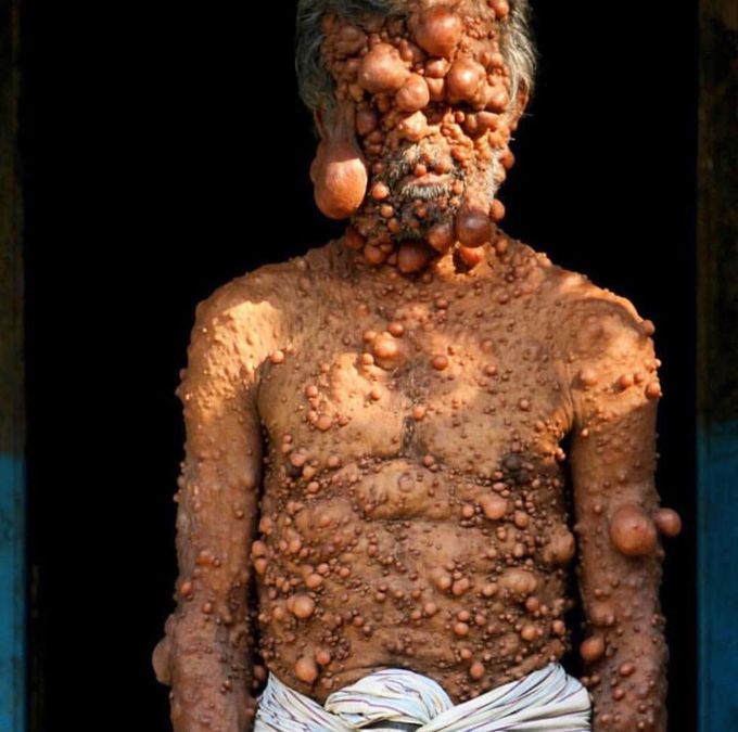 Neurofibromatosis