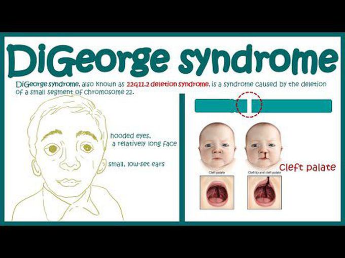 DiGeorge Syndrome: Overview