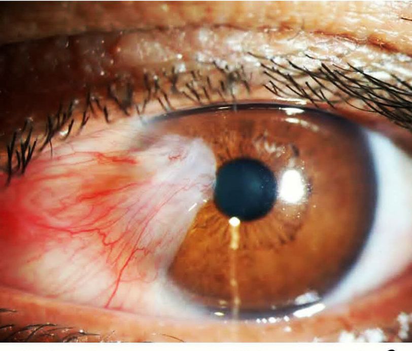 Pterygium (Surfer's Eye ) - MEDizzy