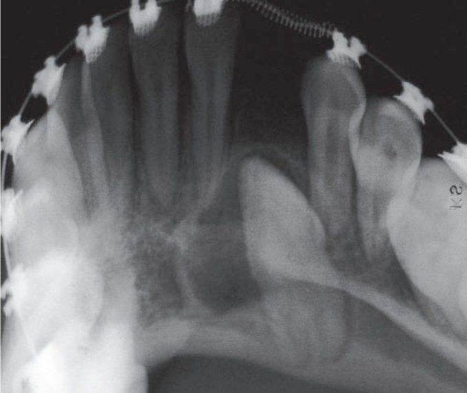 Adenomatoid odontogenic tumor xray