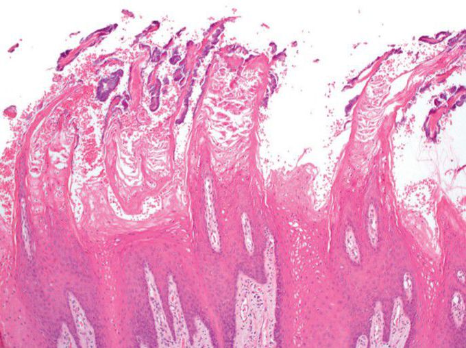 Hairy tongue histopathology