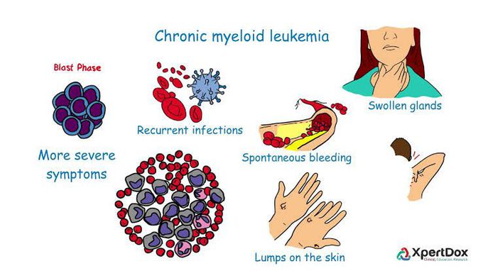 Chronic Myeloid Leukemia Medizzy 