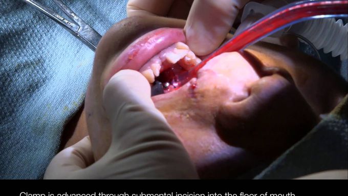 Submental Orotracheal Intubation