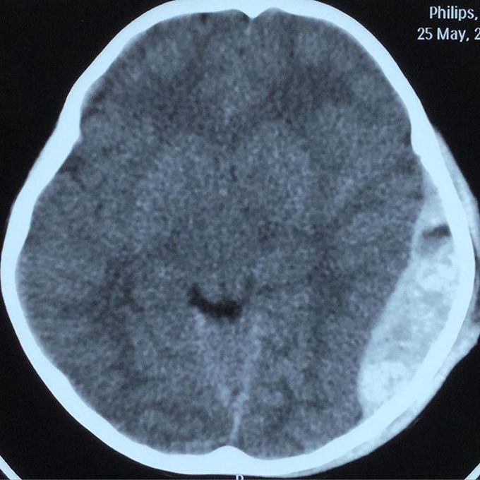 Massive epidural hematoma 