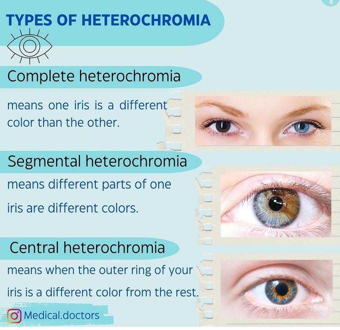 Heterochromia- Types