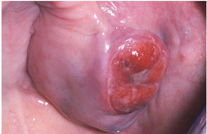 Non-Hodgkin Lymphoma.