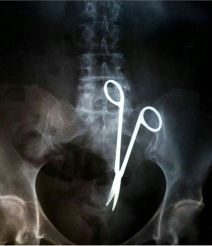 Surgical scissors left in the abdomen