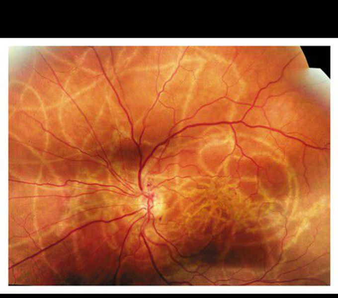 Ocular myiasis