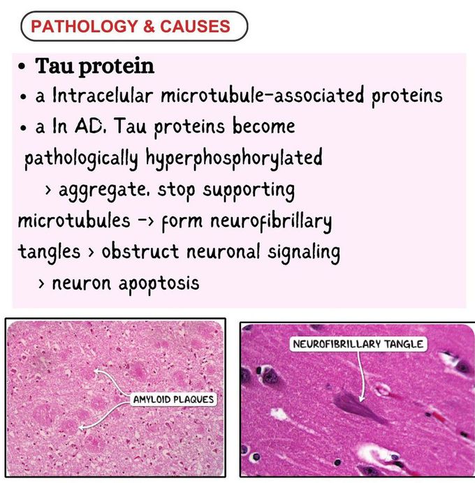 Alzheimer's Disease III