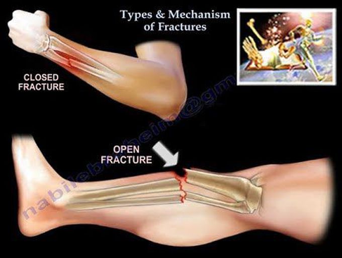 Fracture-Types