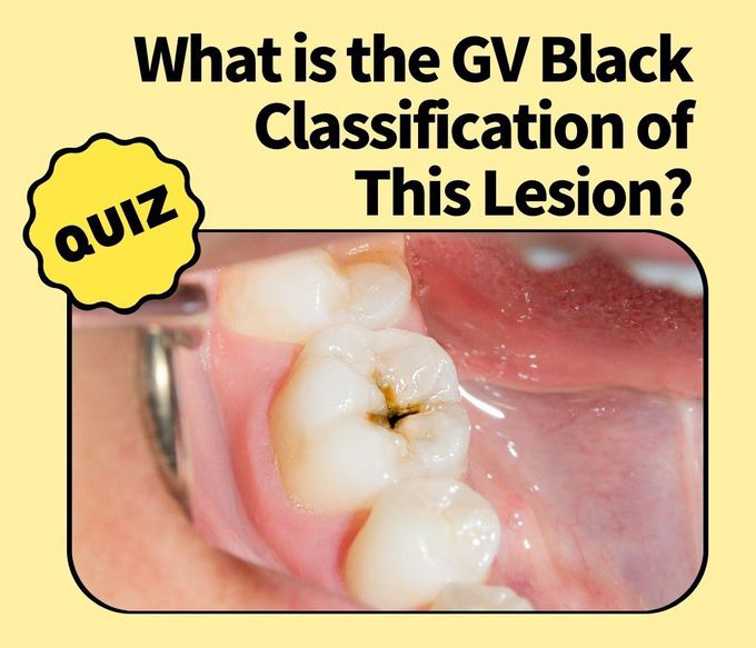 GV Black Classification