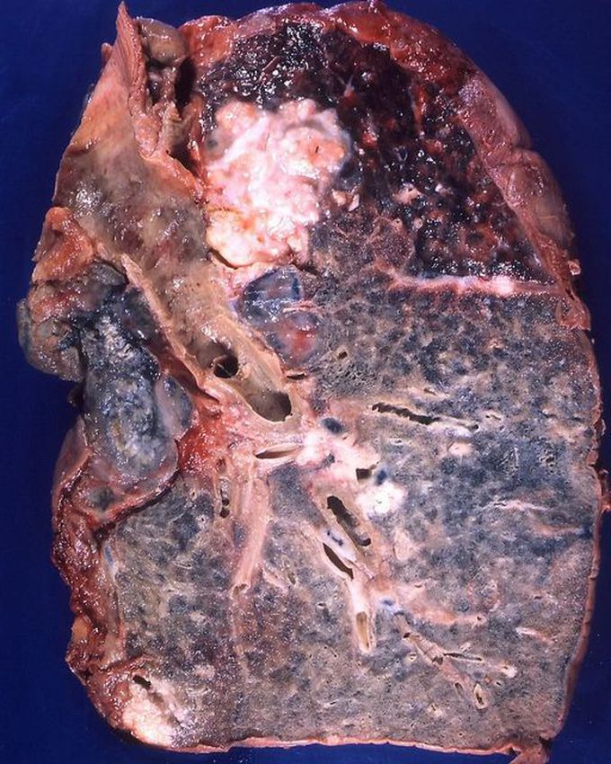 Squamous-cell Lung Carcinoma