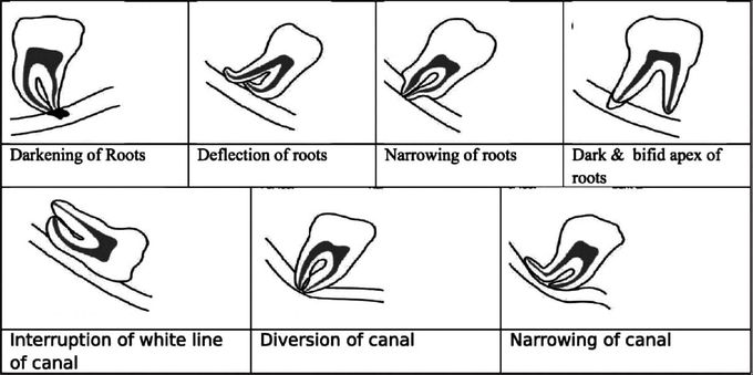 IAN Canal and Mandibular Molar