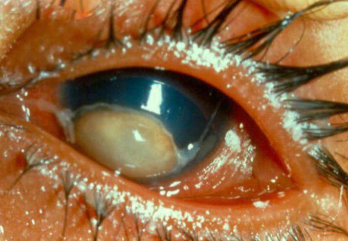 Eye Abnormality