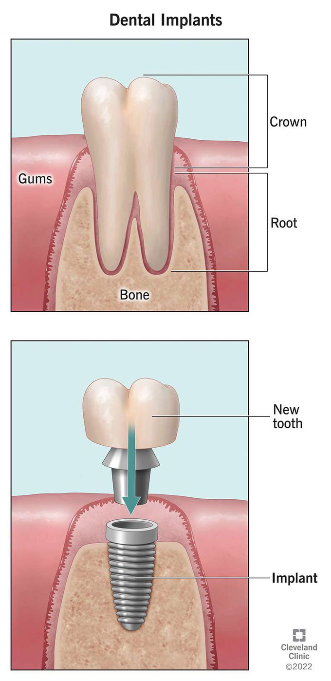 Dental implant surgery