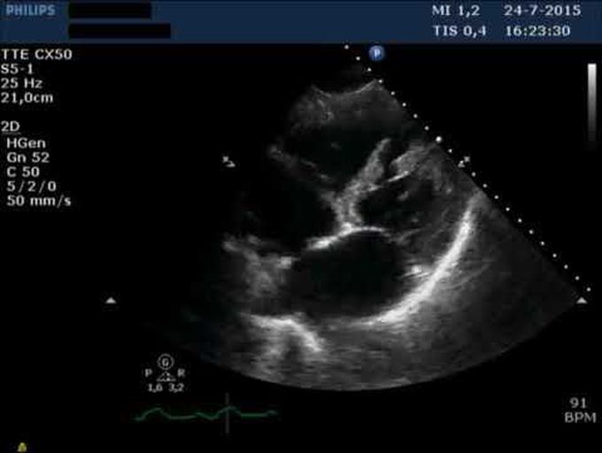 Ventricular Septal Defect after Acute Myocardial Myocardial lnfarction