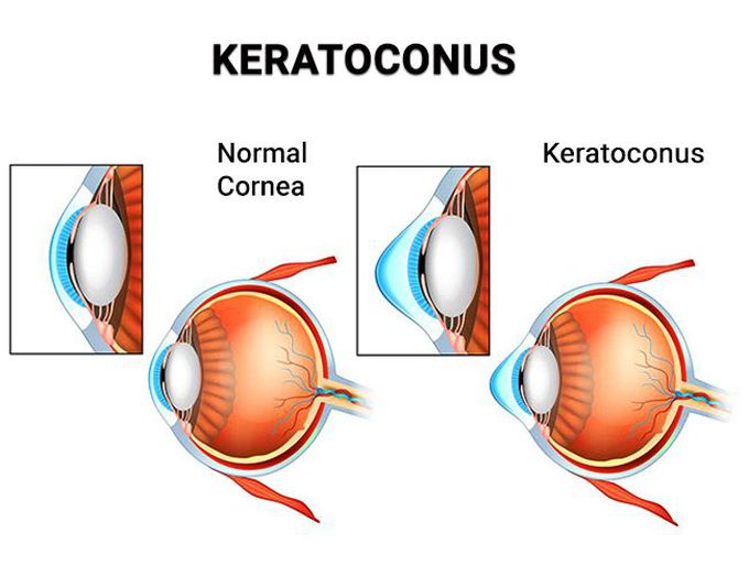 What causes keratoconus?