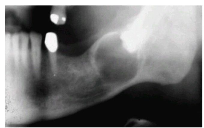 Ameloblastoma