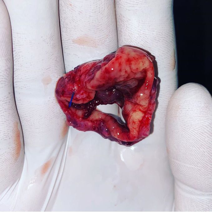 Swollen and inflamed  vein in  rectum and anus