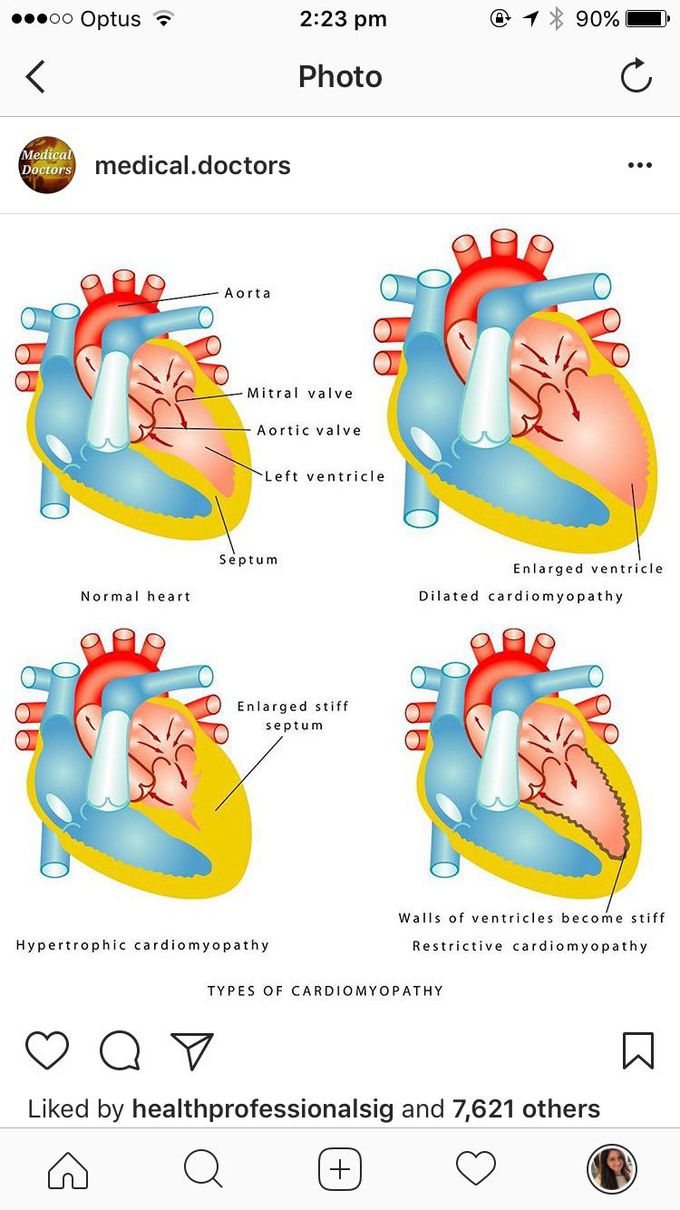 Types of Cardiomyopathy