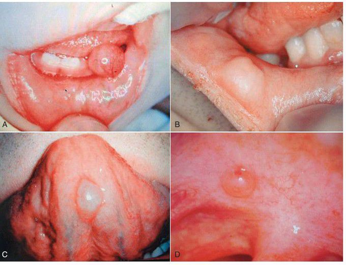 Mucocele