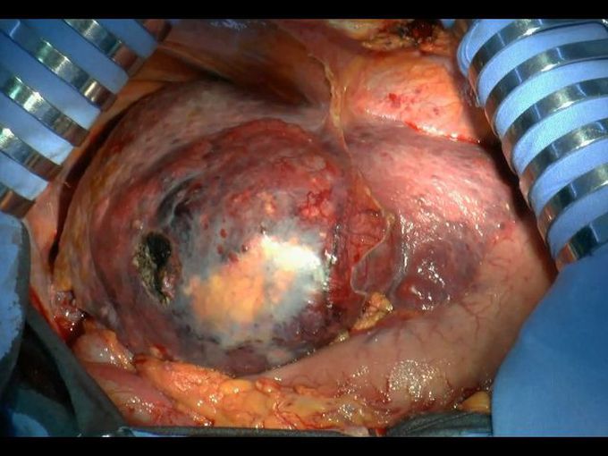 Left Hepatectomy for HCC. Moderataly Severe Cirrhosis (Class B)