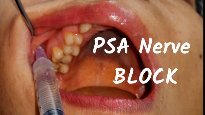 Posterior Superior nerve Block (PSA)