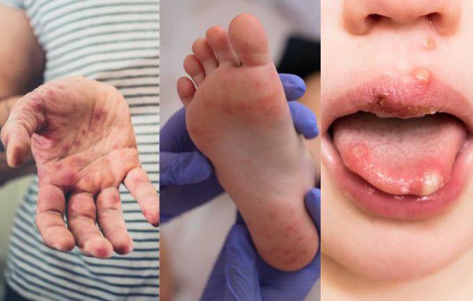 Hand foot mouth disease (HFM)