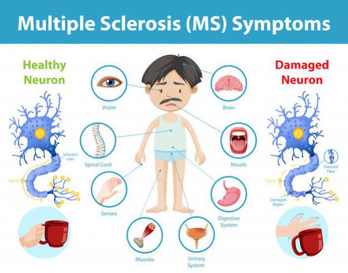 Multiple sclerosis symtoms