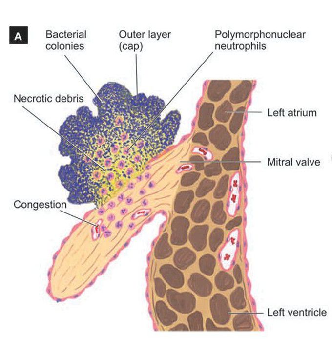 Infective endocarditis