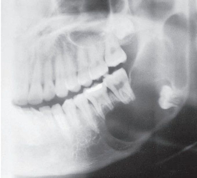 Ameloblastoma