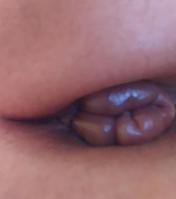 Inflamed hemorrhoids