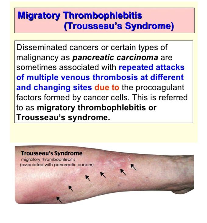 Symptoms of Trousseau Syndrome