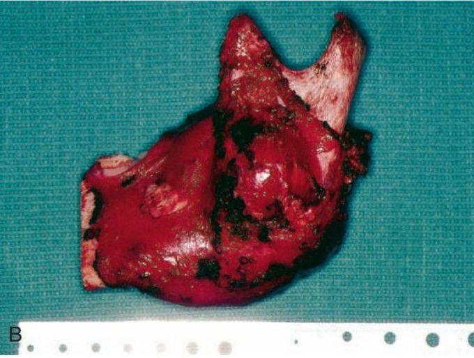 Jaw sarcoma treatment